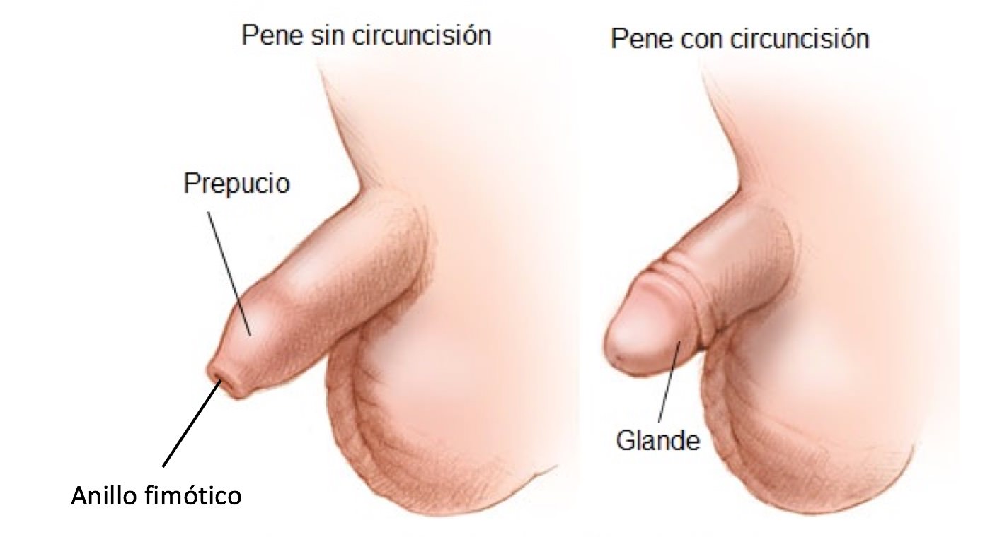 circuncision
